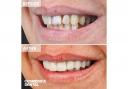 Dental treatment in Turkey